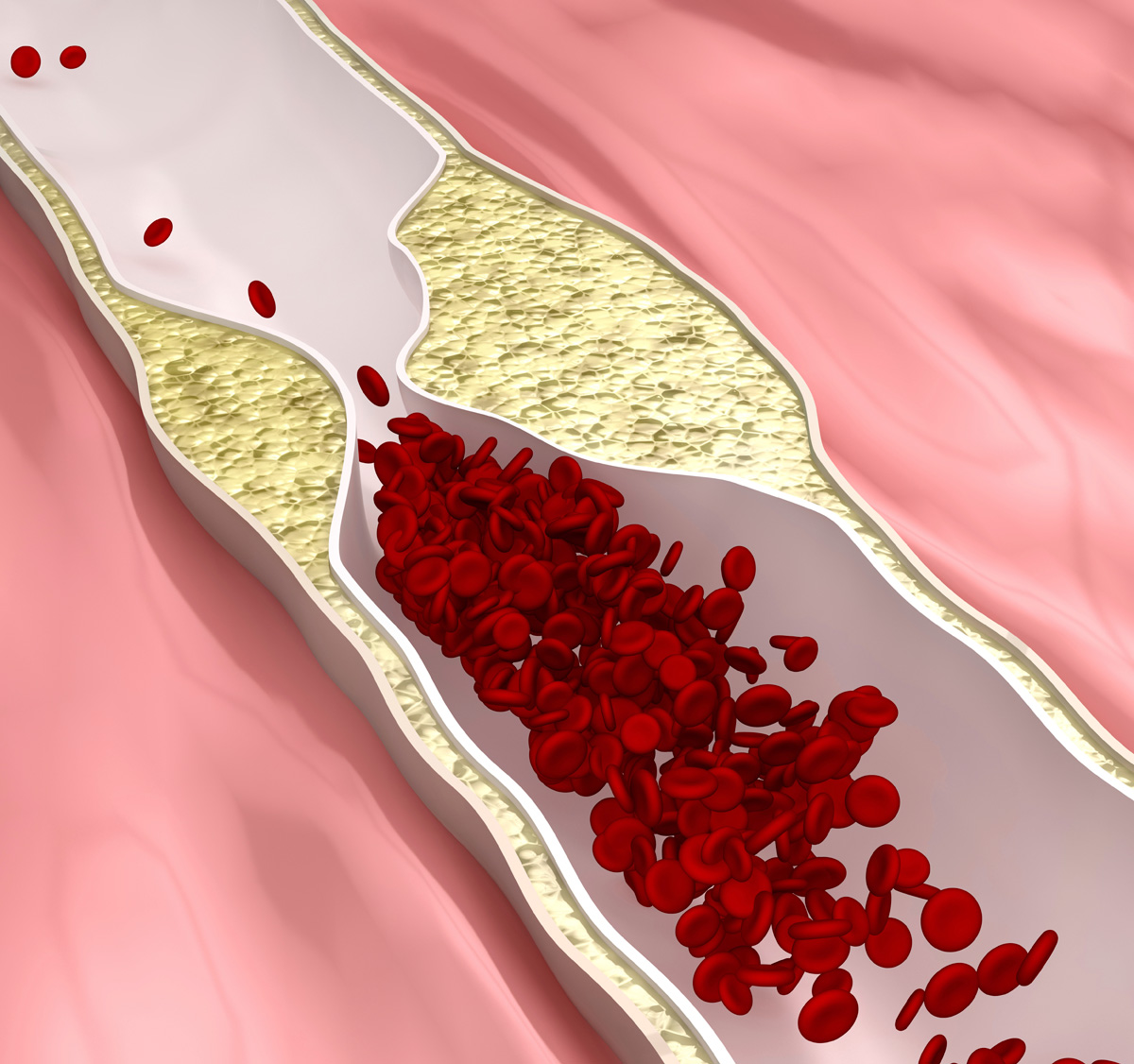 Q&A: How Does Coronary Artery Disease Develop?